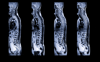 Spinal Cord Injury & Medical Marijuana